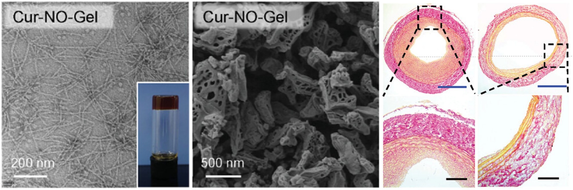 抗狭窄多肽水凝胶助力血管成形术